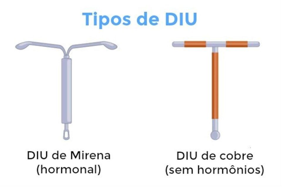 Tipos de DIU colocados pelo ginecologista